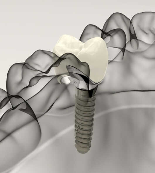 implants